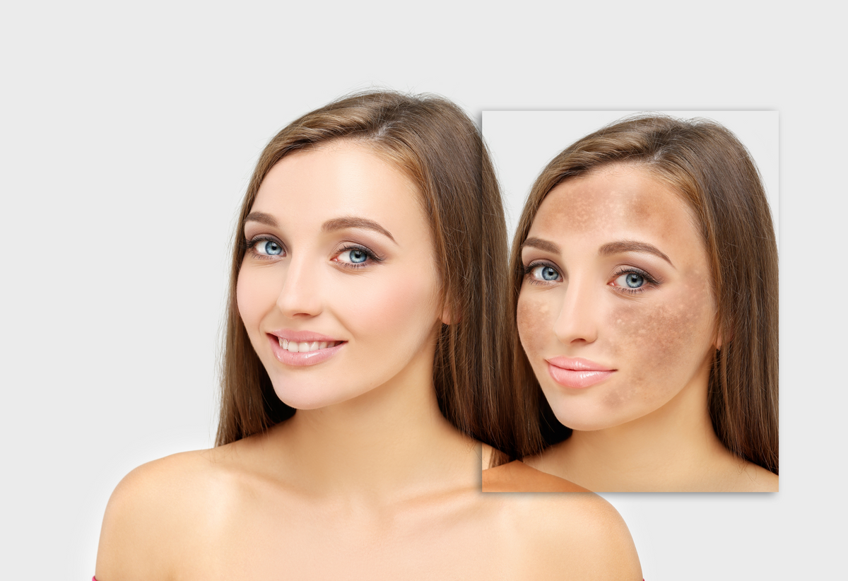 Winter Glow: Embrace Flawless Skin with Pigmentation Treatments